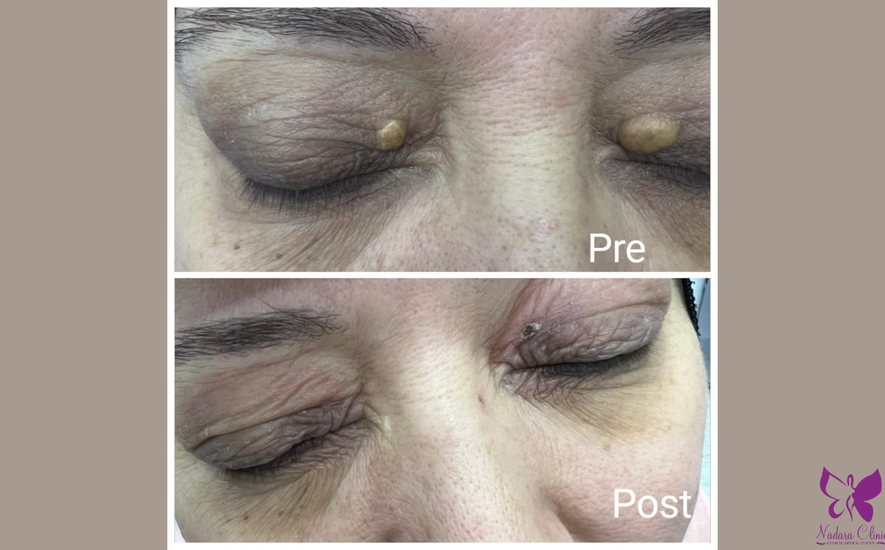 علاج رواسب الكولسترول حول العين في الغردقة